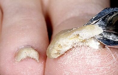 advanced stage of nail fungus infection