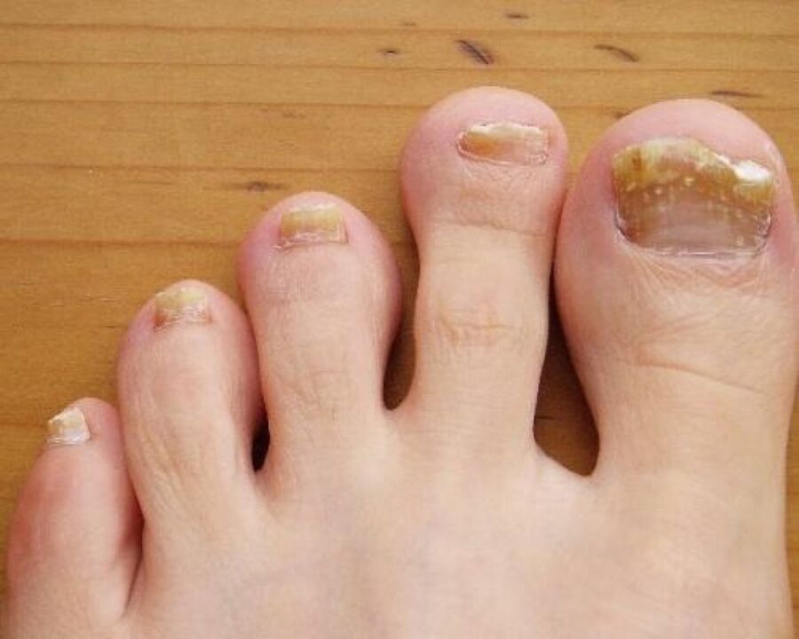yellowing of the nail plate due to fungi