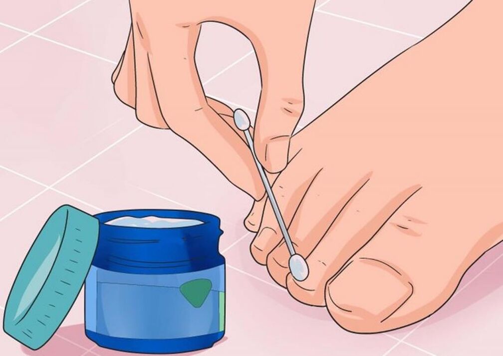 application of ointment for the treatment of nail fungus
