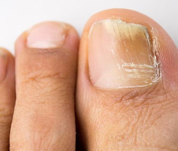 fungal toenail infection