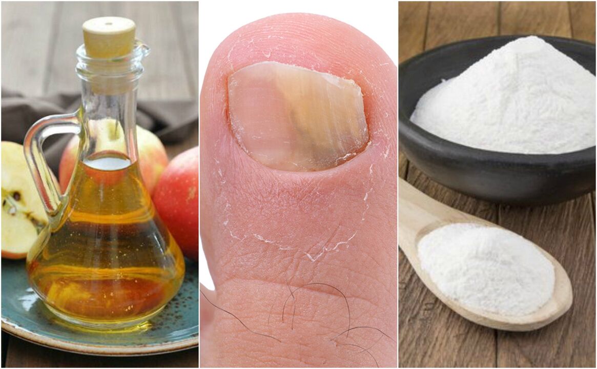 how to cure toenail fungus