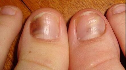 A sign of mycosis is darkening of the nail plate
