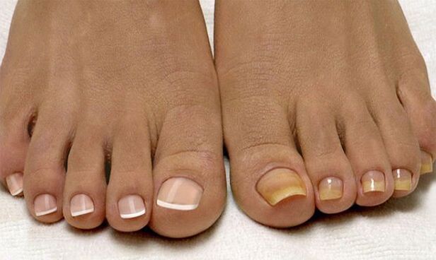 Healthy nails (left) and those affected by fungus (right)