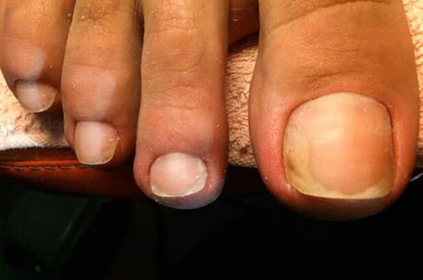 Nail fungus starts on the big toe