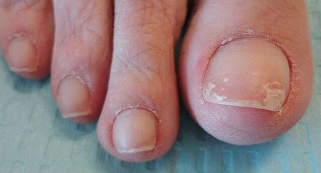 One of the symptoms of onychomycosis is detachment of the nail plate. 