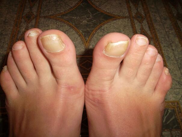 Thickening of toenails with onychomycosis