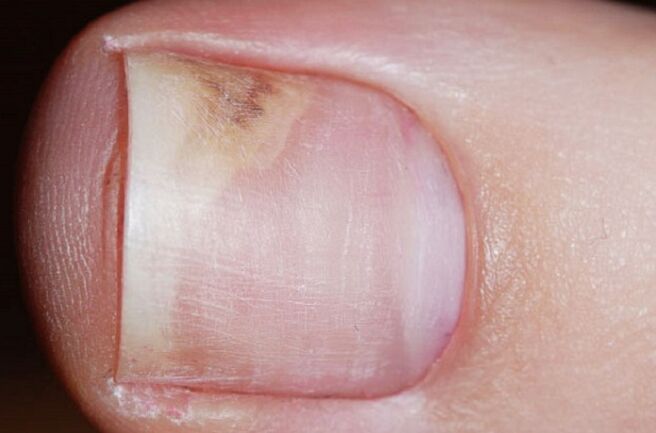 Signs of onychomycosis in the initial stage lack of shine, space between the nail and the bed