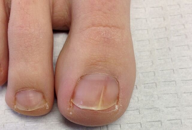 Visual manifestations of toenail fungus in the early stage