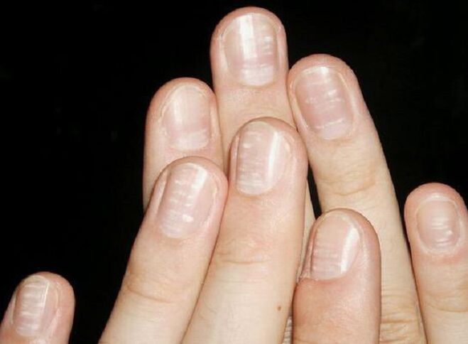 White spots on the nails are a sign of fungal development