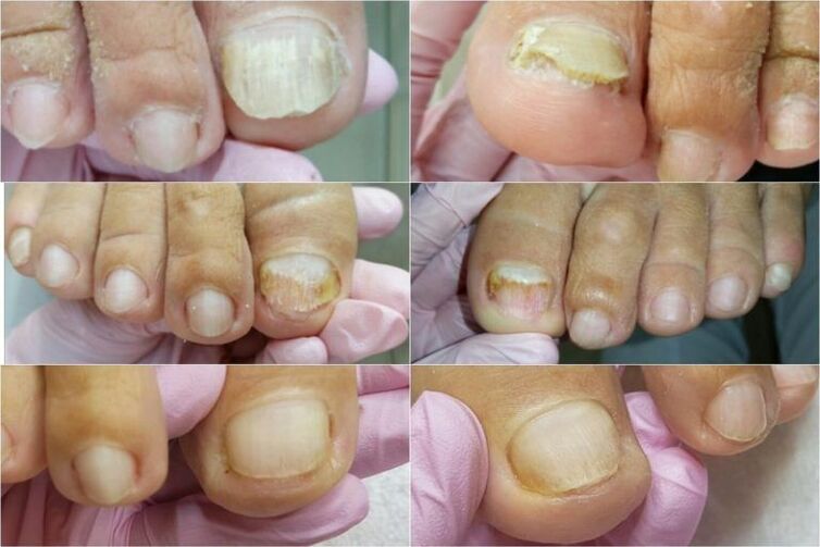 signs of fungus on the nails