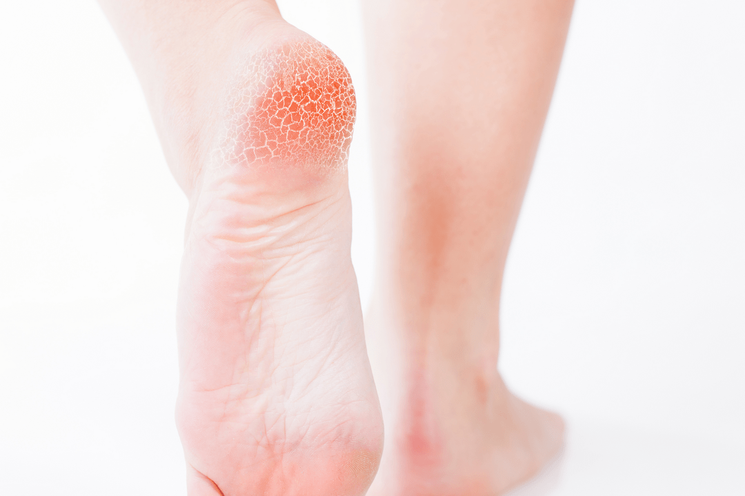 Treatment of foot fungus in early stages