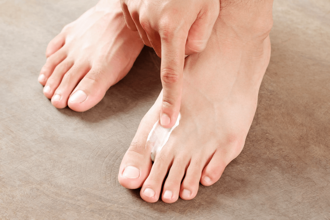 apply antifungal ointment to the skin of the foot