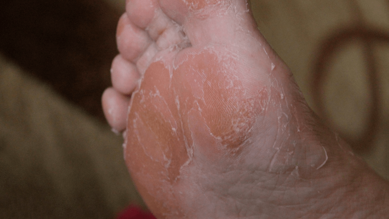 foot skin fungus