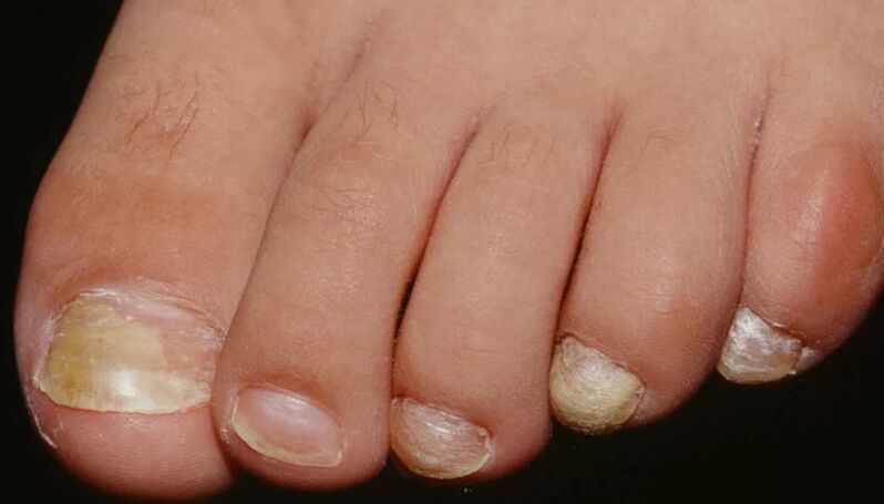 The mushroom of the nails on the thumb