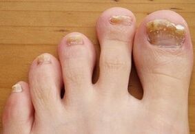 Cotta onicomicosis