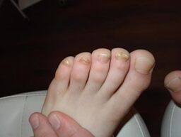 The nail fungus also takes place in children