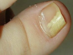 Nail fungus