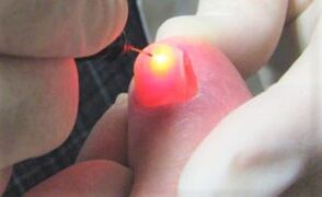 Treatment of the nail fungus with a laser