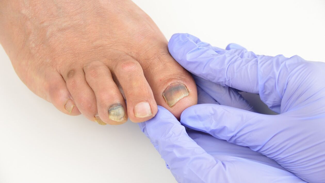 Inspection of the foot mushroom