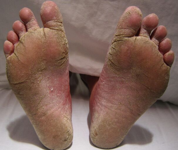 Mycotic defeat of the feet