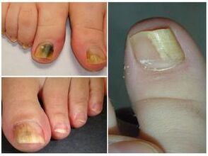 How the mushroom on the nails appears