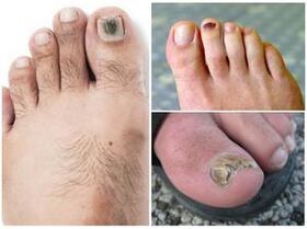 Nail fungus
