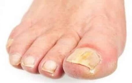 The initial phase of the mushroom on the foot nail