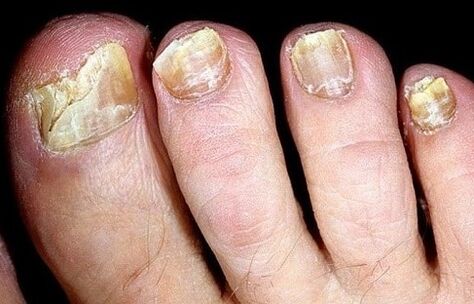 The nails crumble from the mushroom