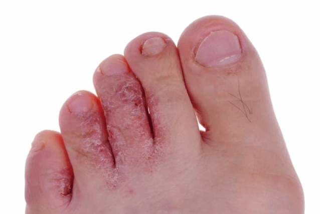 The advanced stadium of mycosis