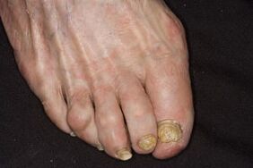 Treatment of the nail fungus on apple cider vinegar legs