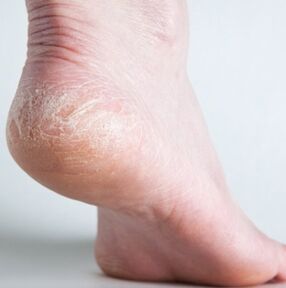 diagnosis of nail mycosis