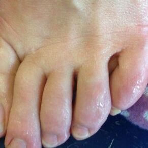 routes of fungal infection