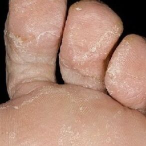 stages of nail fungus