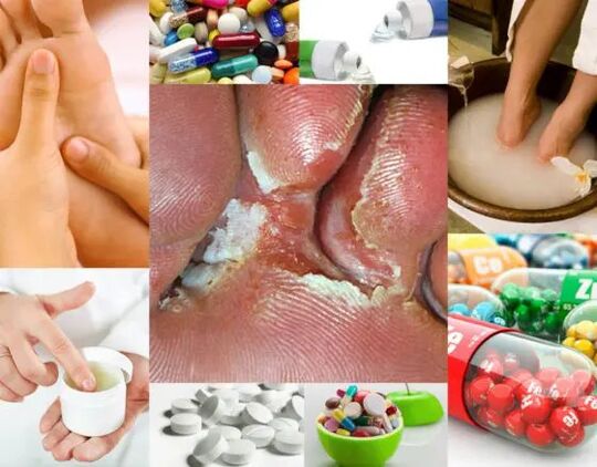 Interdigital mycosis and treatment methods