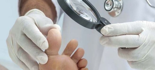 Tests before starting fungal treatment