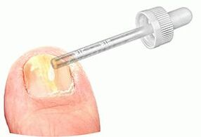 Application of medicinal drops to a nail affected by fungus
