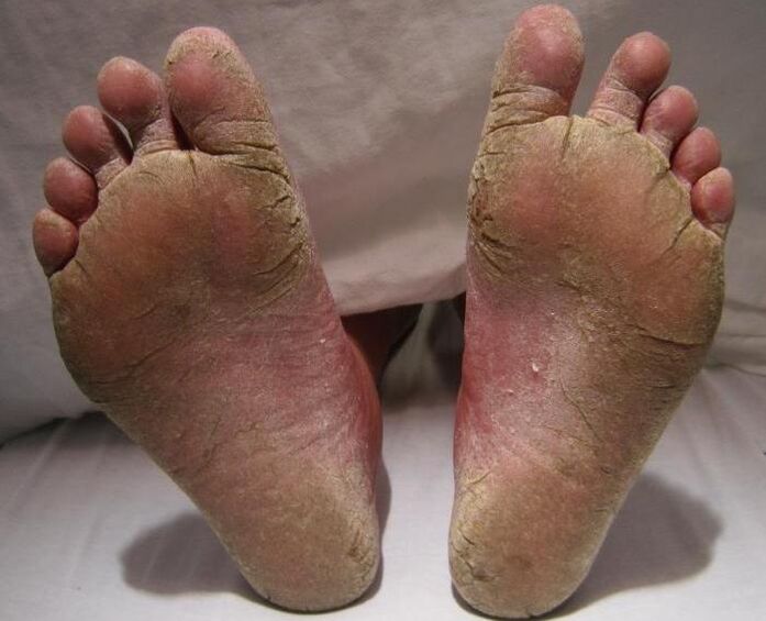 scaly-hyperkeratic fungus on the legs