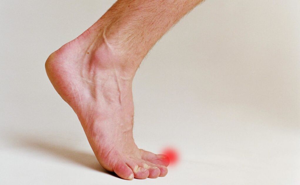 Nail fungus on big toe