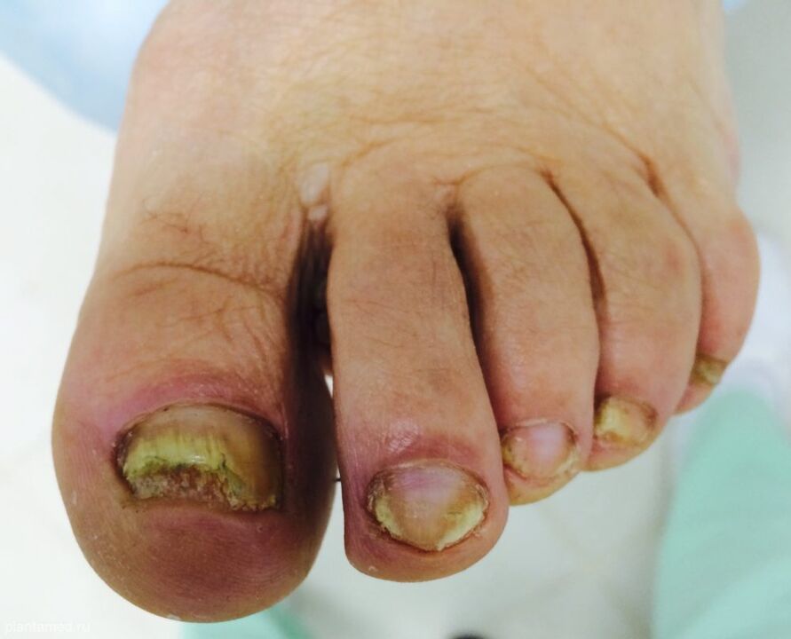 Severe deformation of the toenails is a sign of the advanced third stage of the fungus