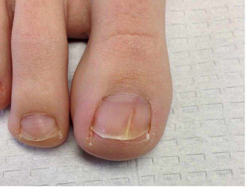 Streaks and spots on the big toe nail during the early stage of fungal development
