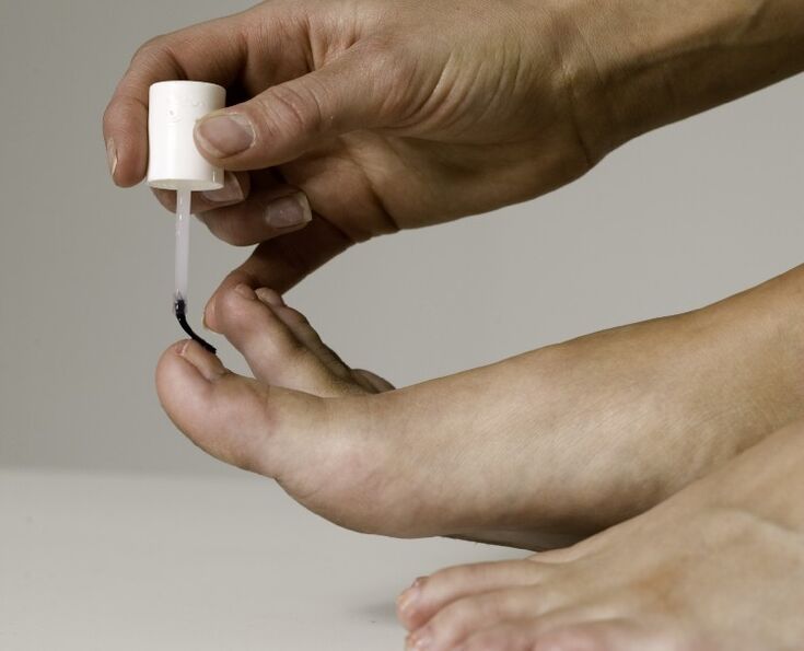 The use of medicinal varnishes for the treatment and prevention of onychomycosis on the big toe