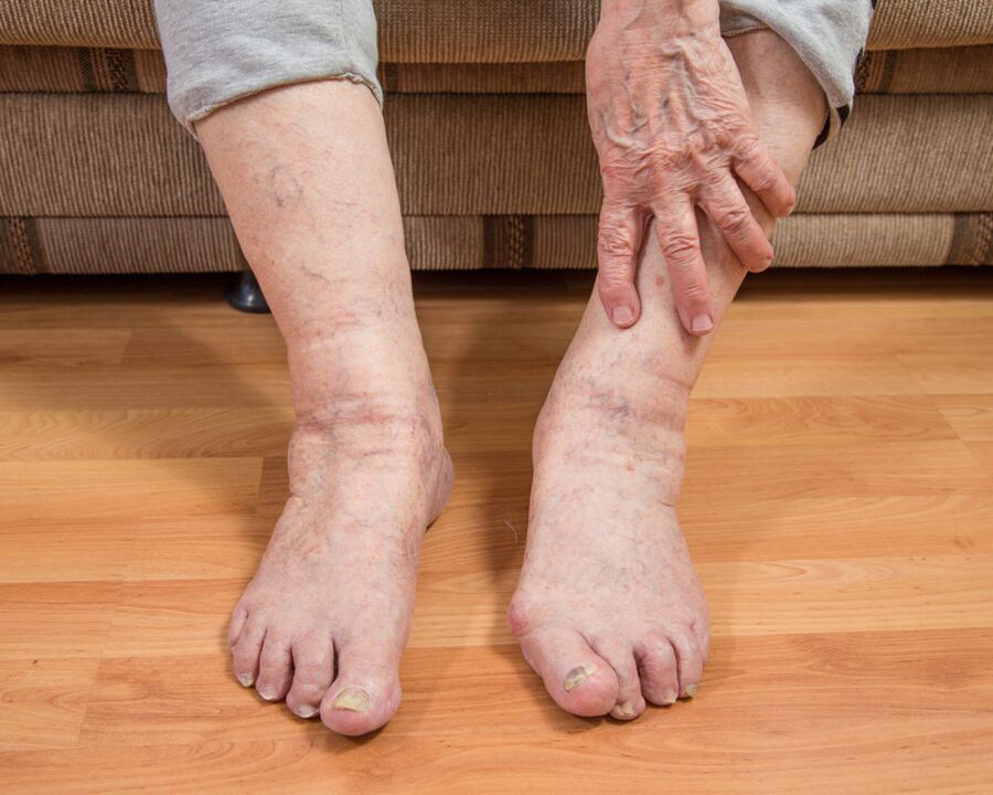 To avoid the spread of fungal microspores, do not walk barefoot indoors.