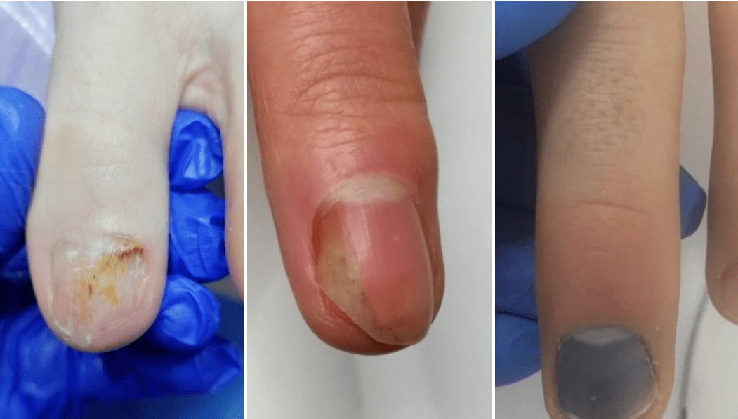 what nail fungus looks like